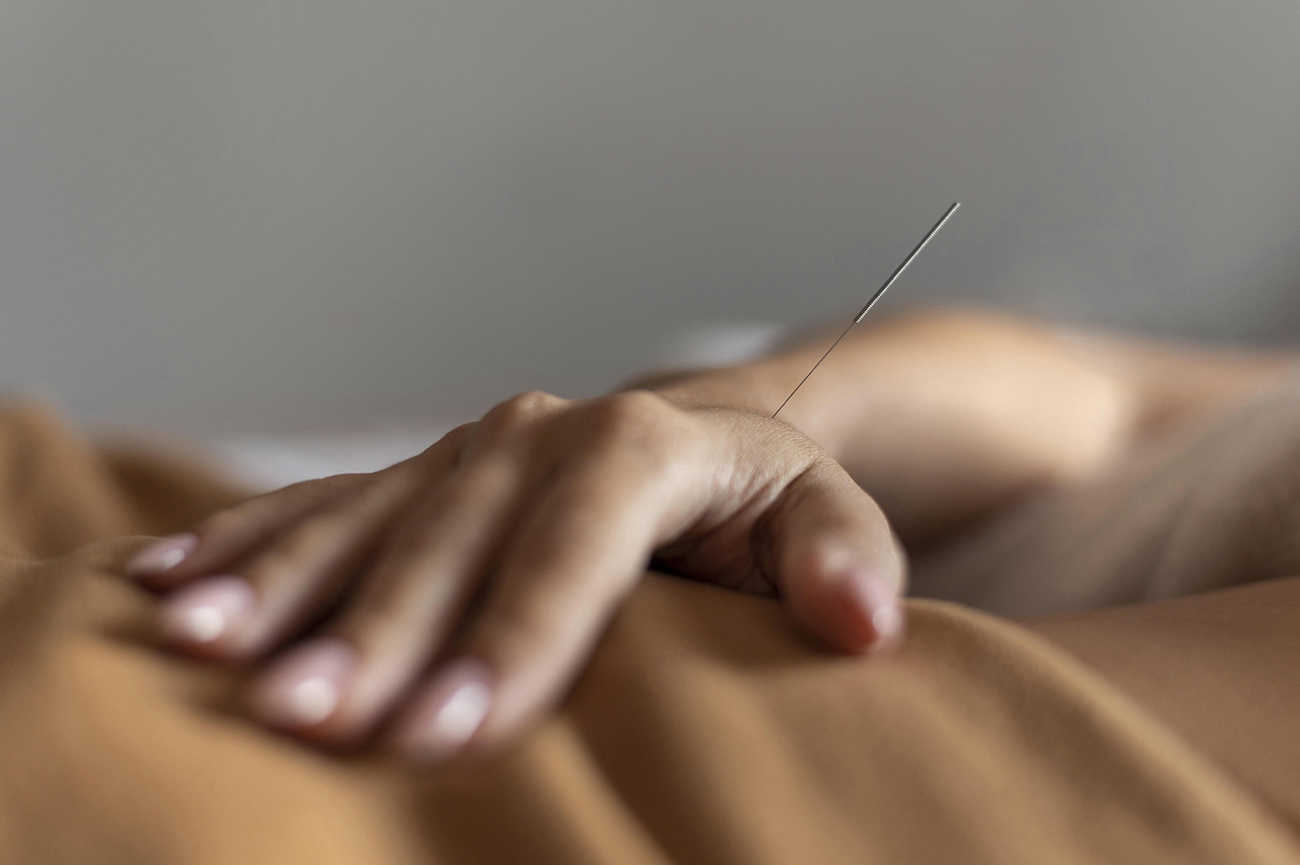 Dry needling